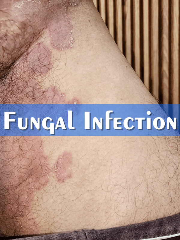 Fungal Infection Treatment